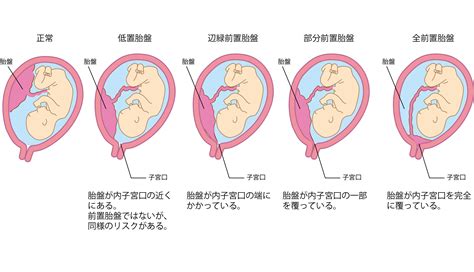 胎盤形成出血|【医師監修】妊娠中 の胎盤の役割は？胎盤の異常で。